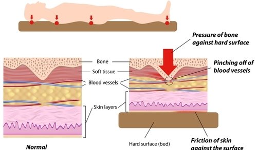 wound Support